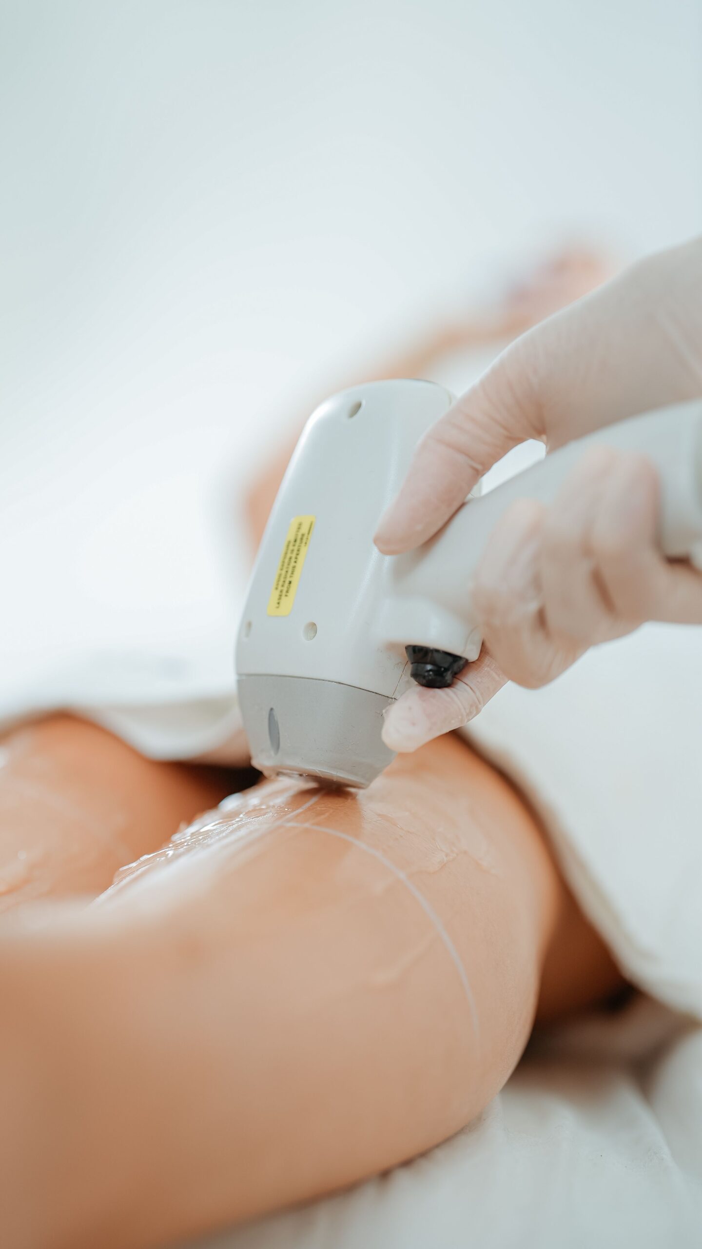 Är permanent hårborttagning med diodlaser värt det?